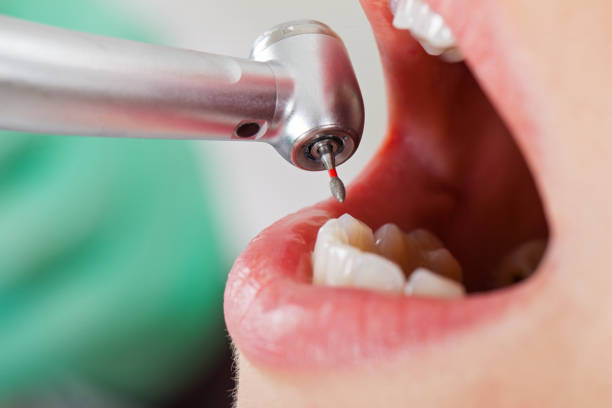 Best Emergency Dental Extractions in Mcminnville, OR